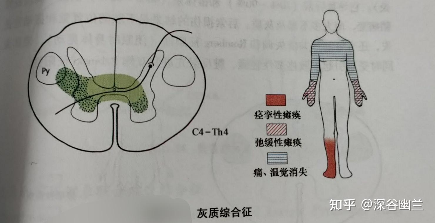 灰质综合征:引起中央灰质损害的病变,如脊髓空洞症,脊髓出血和髓内