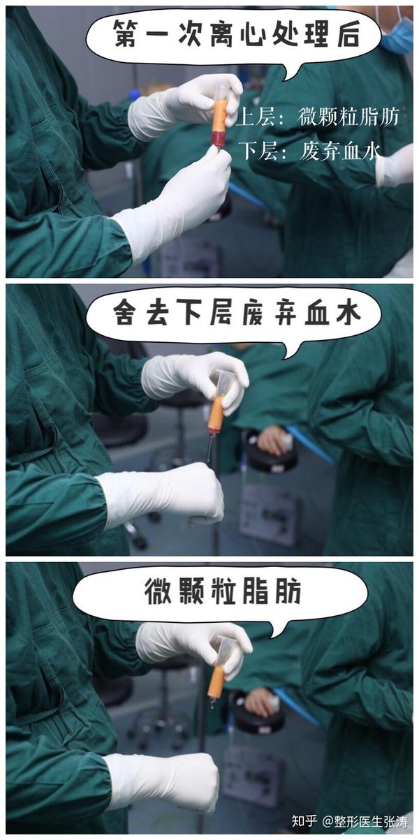 脂肪移植黑科技——SVF-gel脂肪干细胞胶 - 知乎