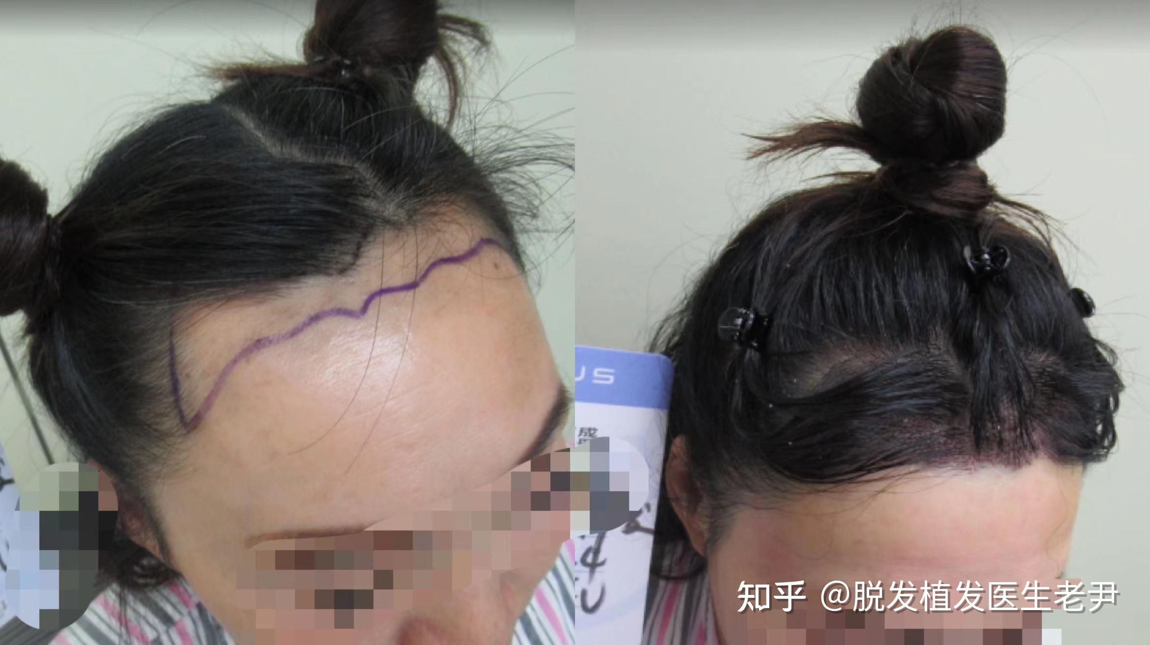 植发需要多少钱？ - 知乎