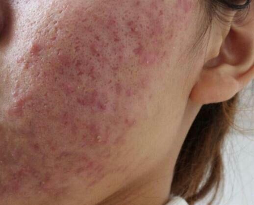 高中青春期满脸痘让我很自卑共勉