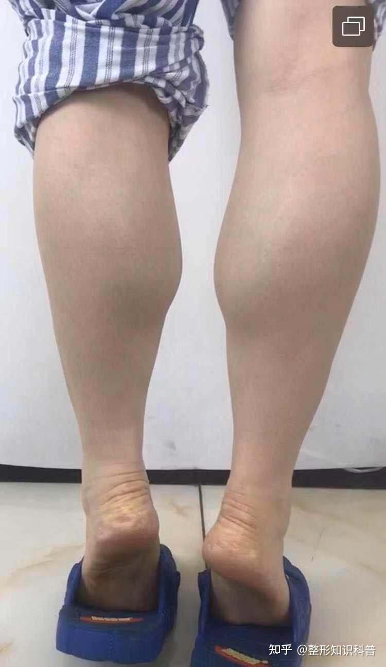 重复错误的发力点会让小腿越发粗壮,例如:很多女生在穿高跟鞋的时候