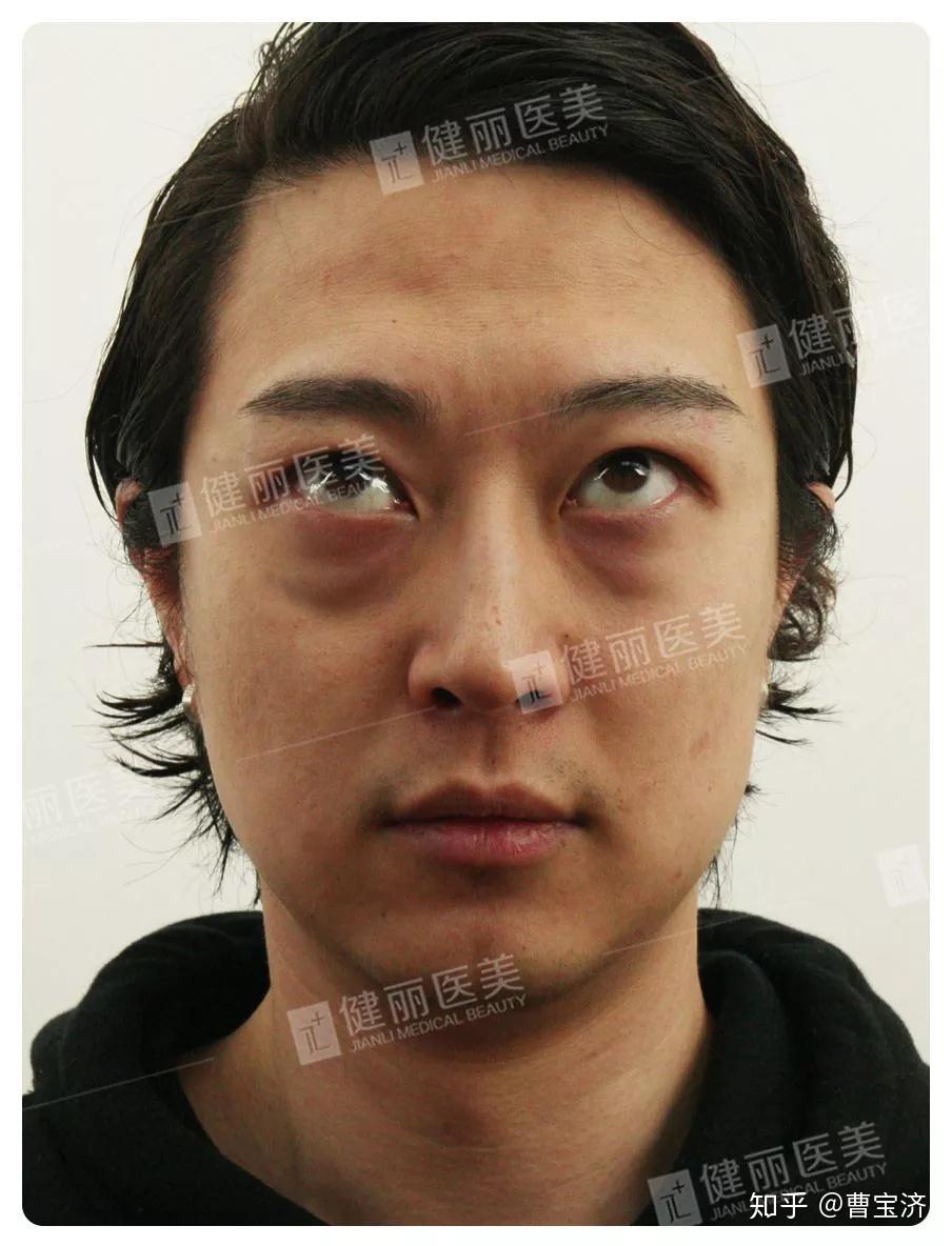 男人不去眼袋没影响34岁男士术后多角度高清照曝光