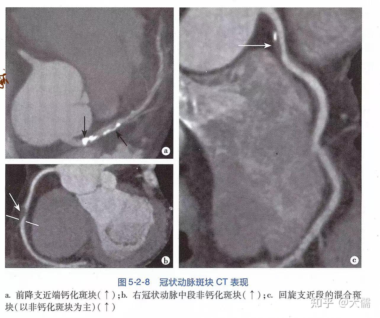 冠状动脉 CT 血管成像 - 知乎