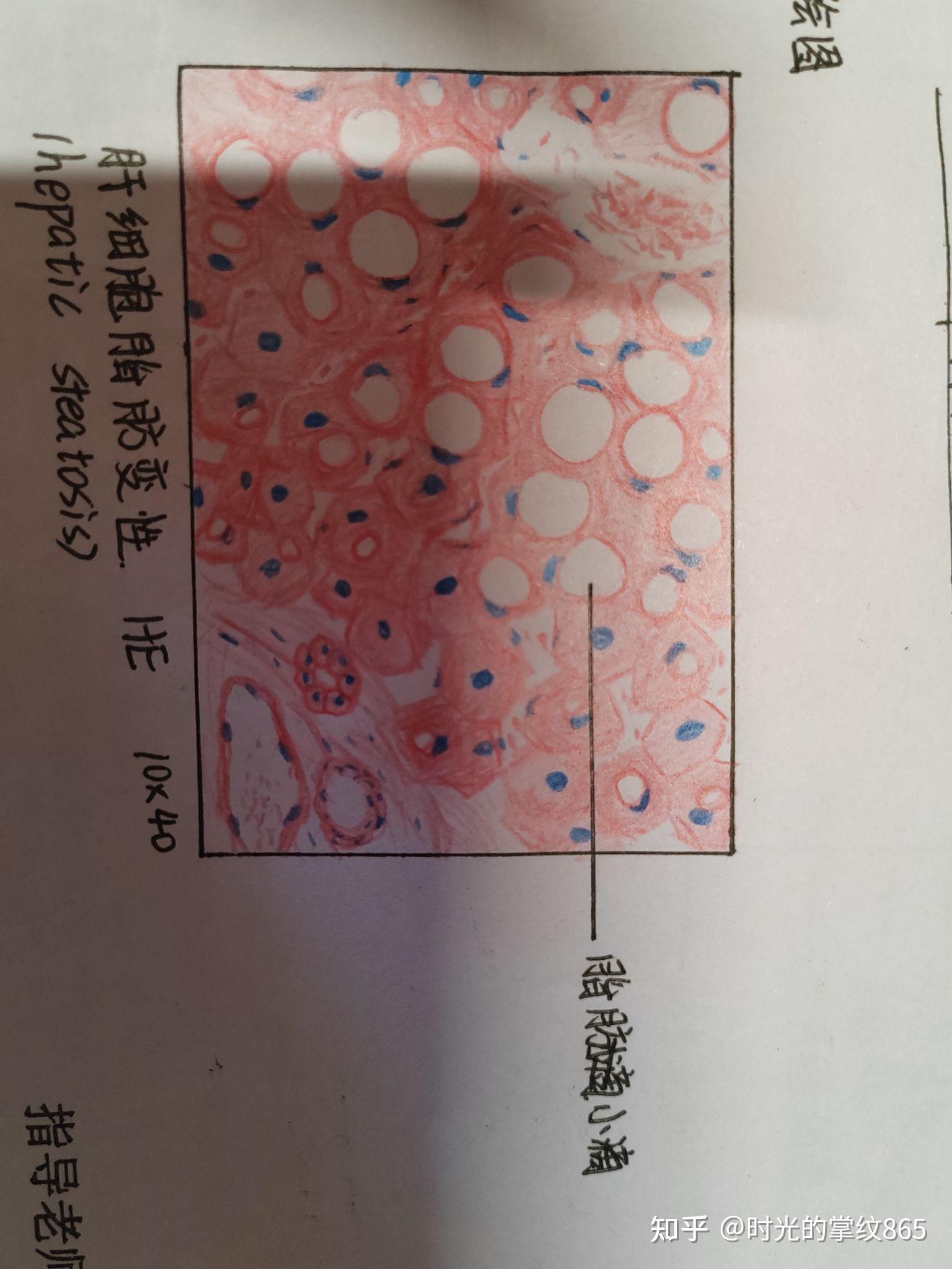 乳腺纤维腺瘤(再看还是觉得这个好丑哈哈哈)8.鳞状细胞癌9.