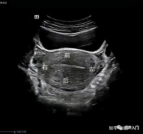 超声下如何区分宫体前后壁? - 知乎