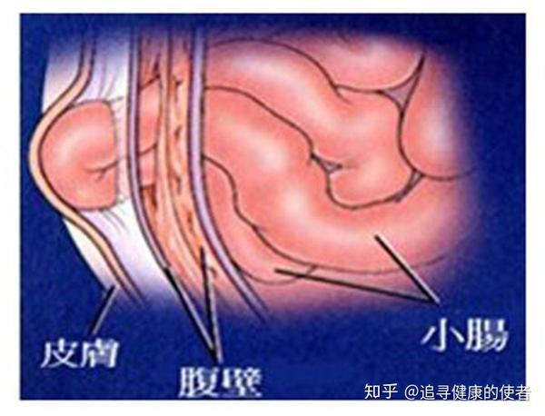 小儿得了疝气就一定要开刀吗 知乎