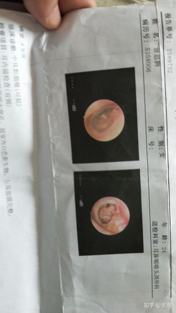 我的中耳炎鼓膜穿孔听小骨重建手术经历