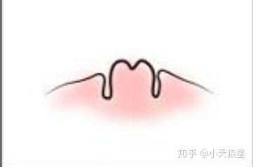 乳头内陷怎么办 需要做手术吗 知乎