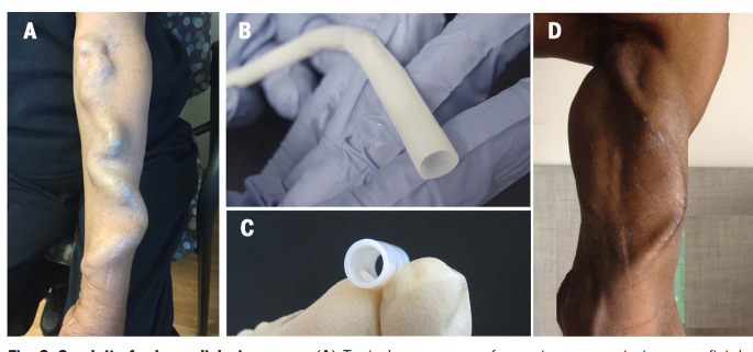 science人造血管发展简史