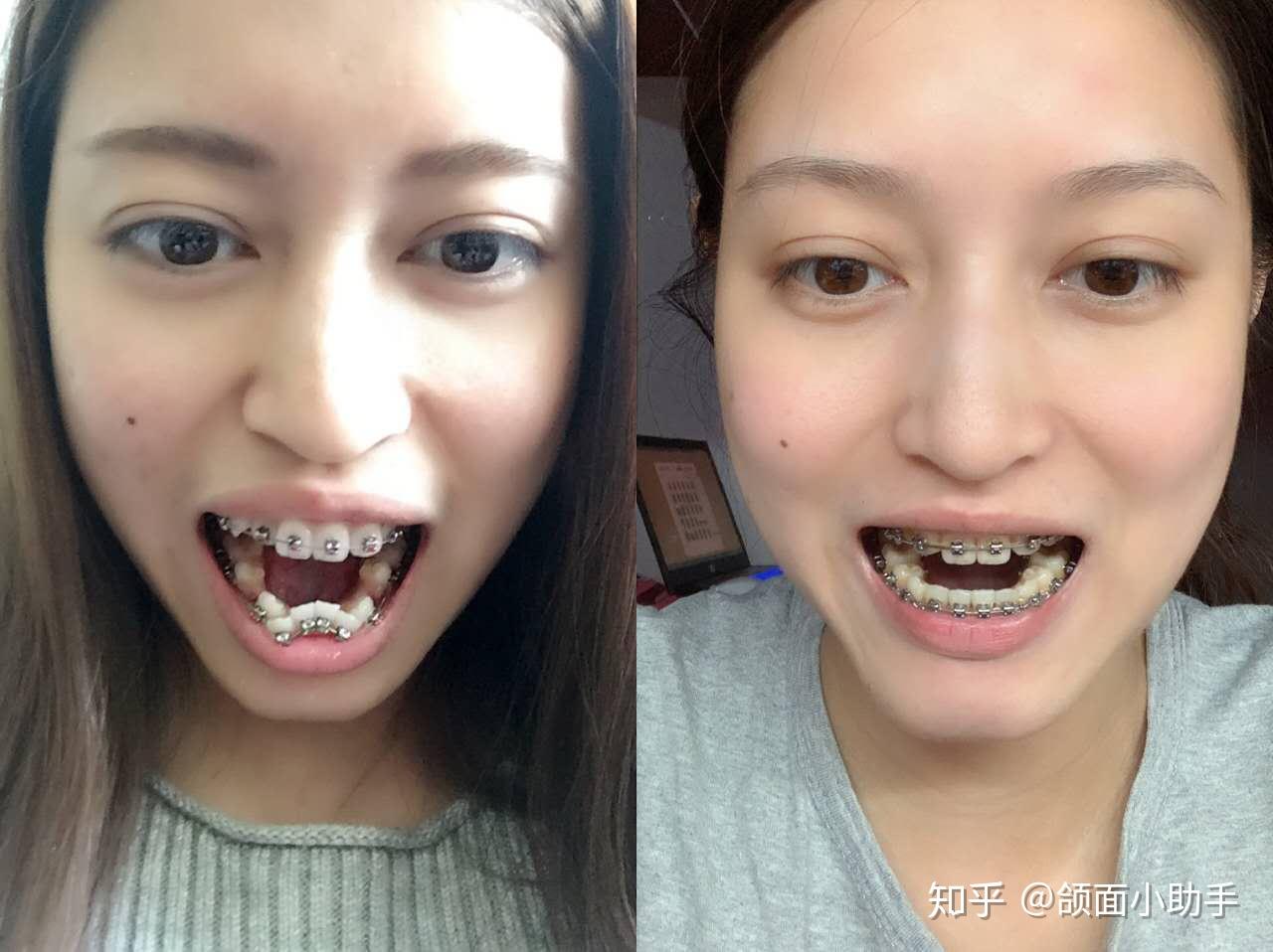正畸拔牙对身体有副作用吗
