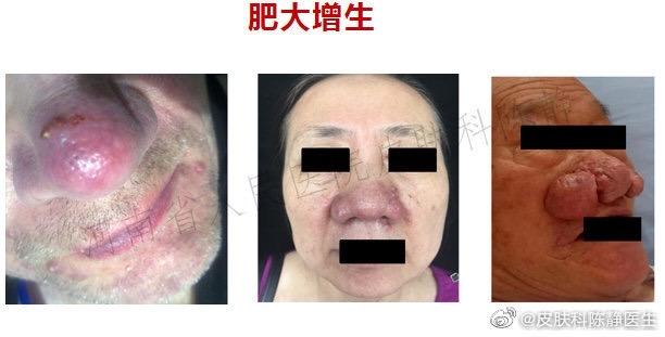 脸红可以看皮肤科吗女（脸红可以看皮肤科吗女生） 酡颜
可以看皮肤科吗女（酡颜
可以看皮肤科吗女生）《颜肤堂皮肤病研究所》 女科知识