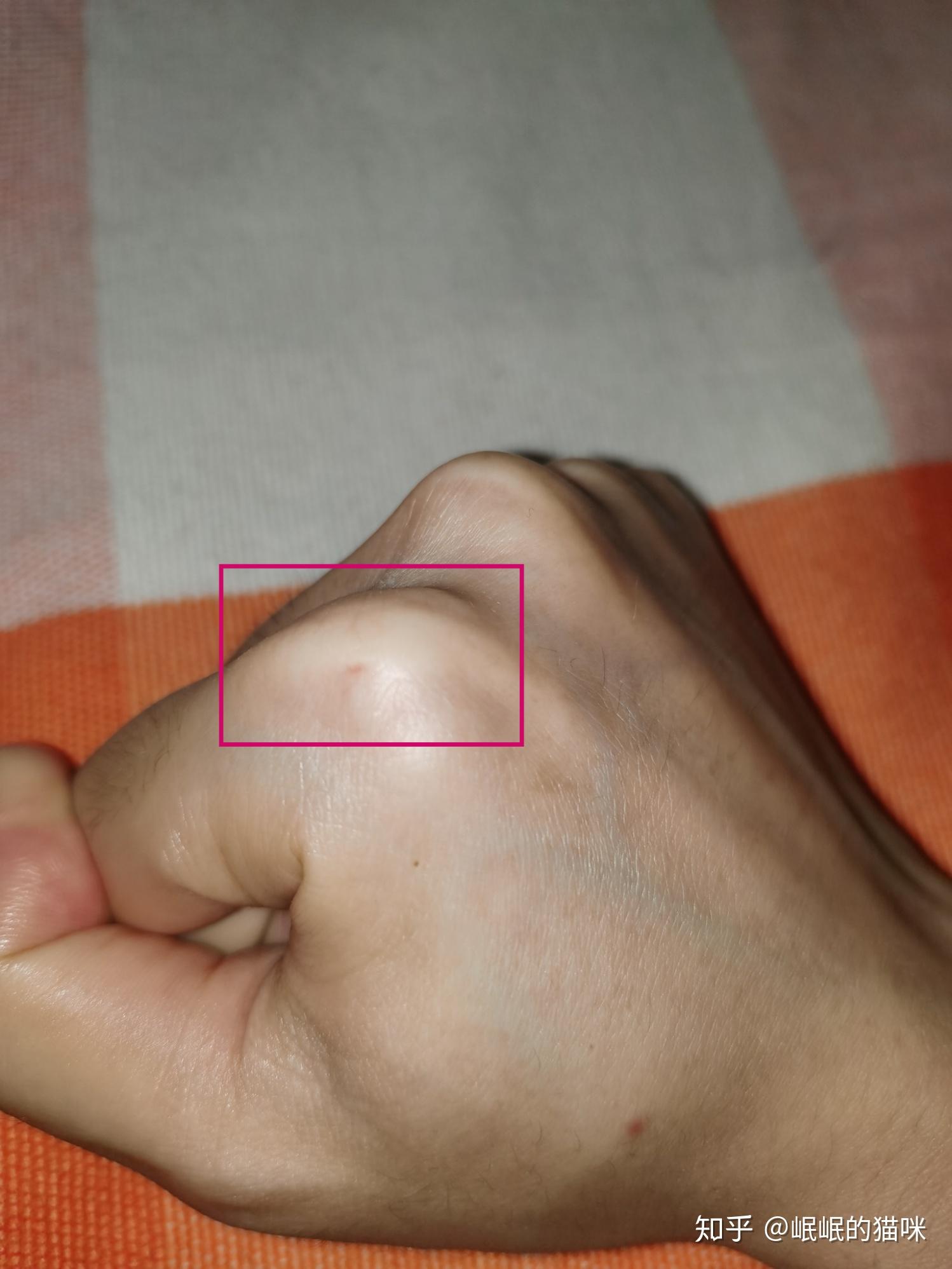 被家养的两个月小奶猫抓伤,伤口不深,它没打过针.