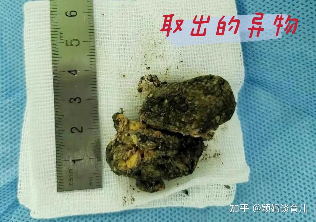 女童连吃6块柿饼紧急上医院医生取出巨大结石给娃吃柿要四不