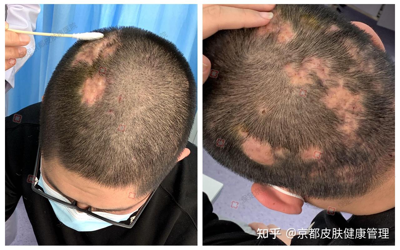 17岁少年患穿掘性毛囊炎,做家长的都看看吧