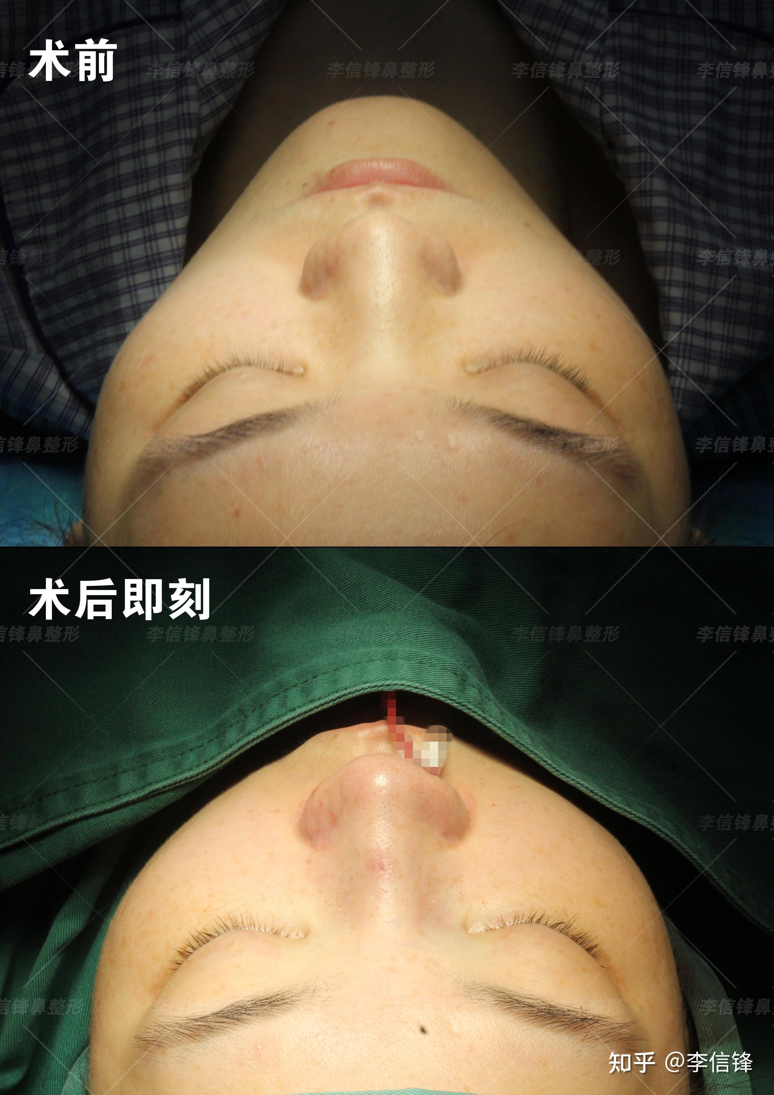潮汕美女短塌鼻逆袭|鼻骨宽 + 鼻翼肥厚 + 面中凹陷,膨体肋软骨鼻综合术后即刻对比~ - 知乎