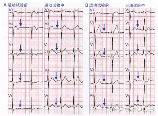 u波 朱晓晓心电资讯 专注心电技术和产品,聚焦心电前沿,为你速递最新