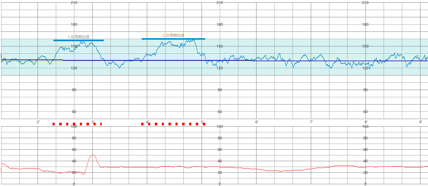 什么是胎心率加速? - 知乎