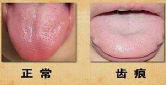 牢记这三点远离脾虚湿气重