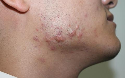 脸上的疤痕疙瘩怎么处理?