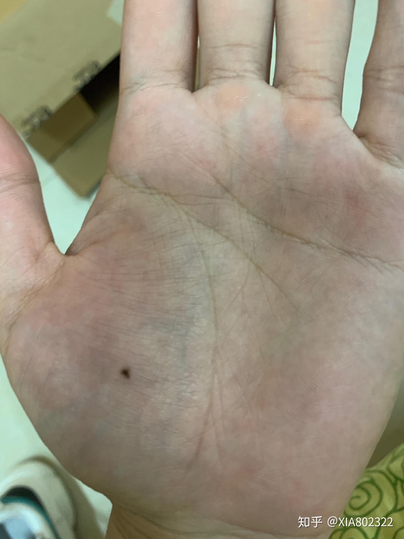 本人女,十八九岁时左手掌长了个痣是什么原因?