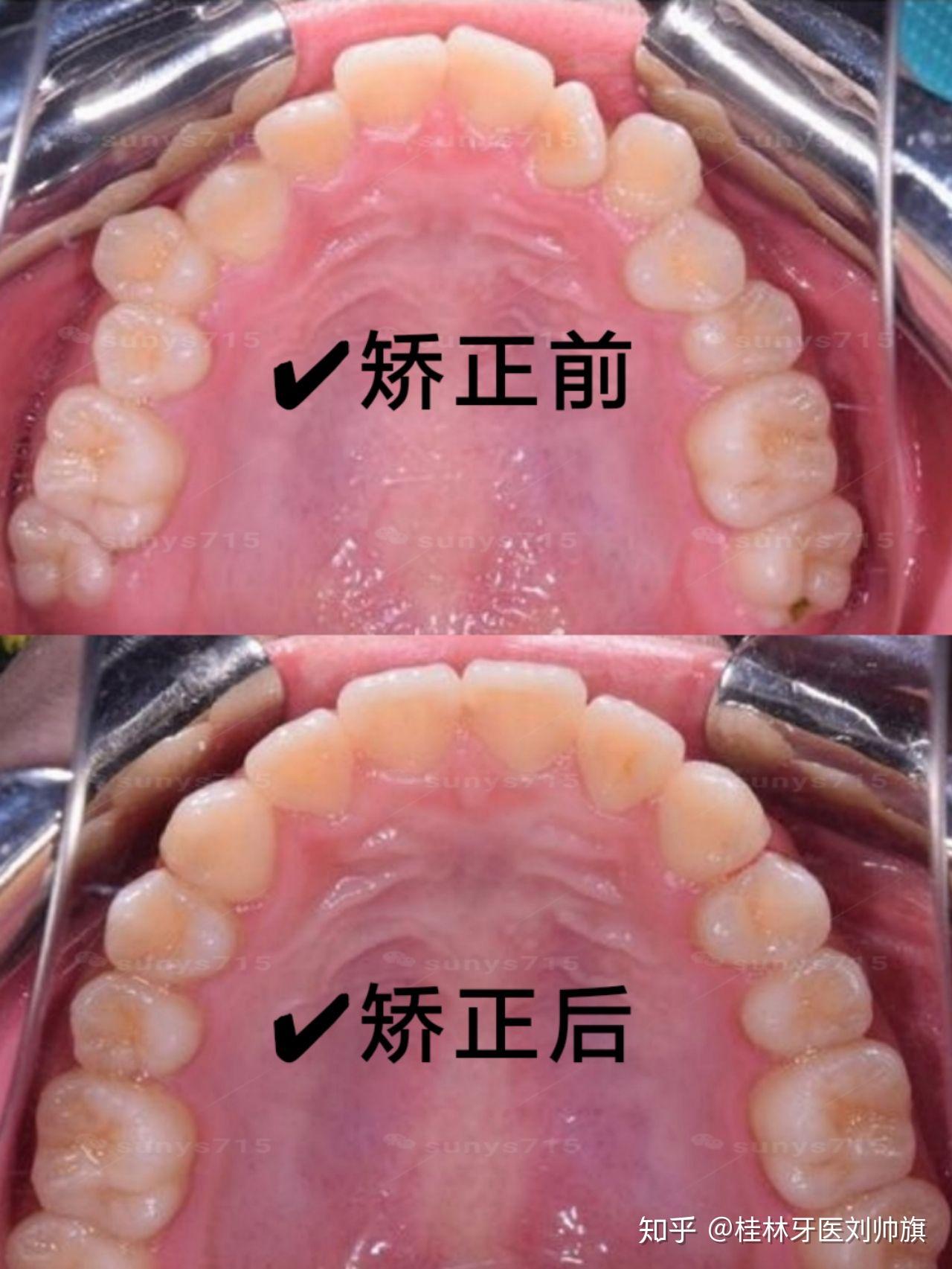 桂林正畸牙齿拥挤77咬合不齐