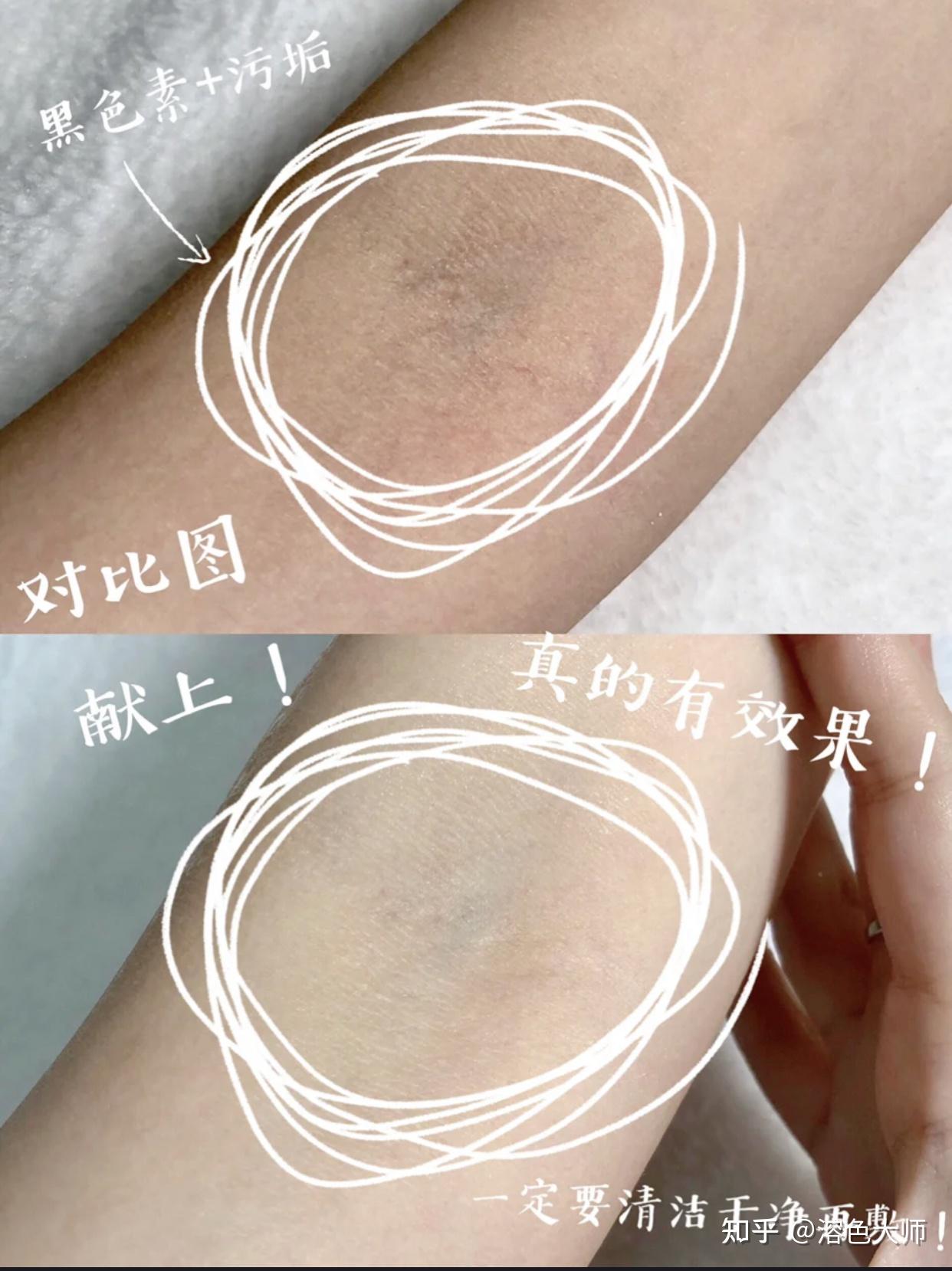 想了解下关节黑色素沉淀怎么去除?