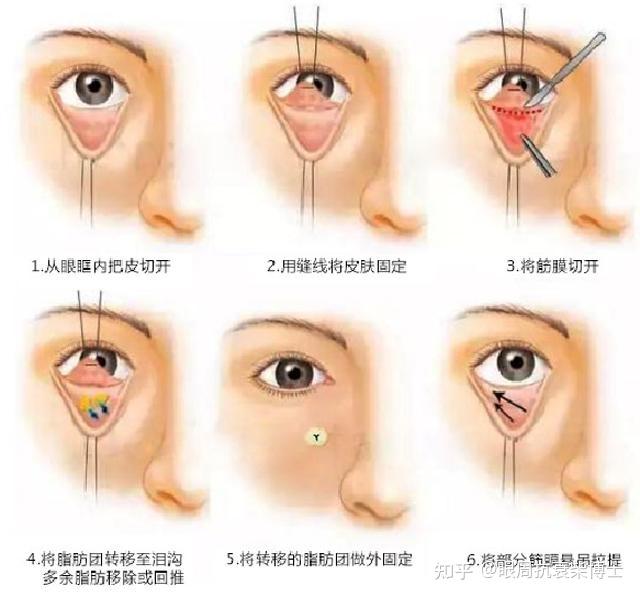 最全眼窝凹陷解析你还在为它而困扰吗