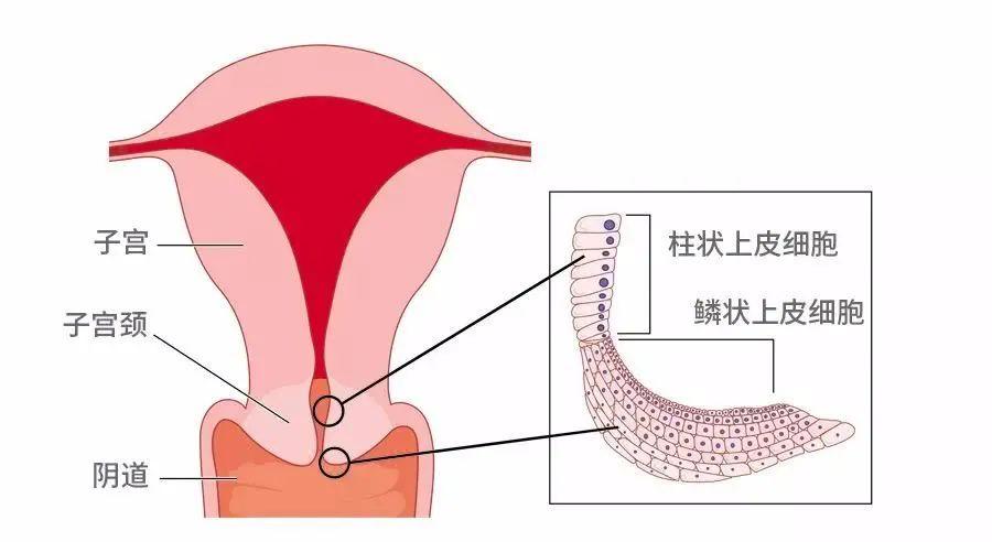 宫颈糜烂可以说是最容易被误解的疾病了,糜烂两个字看起来就像病入