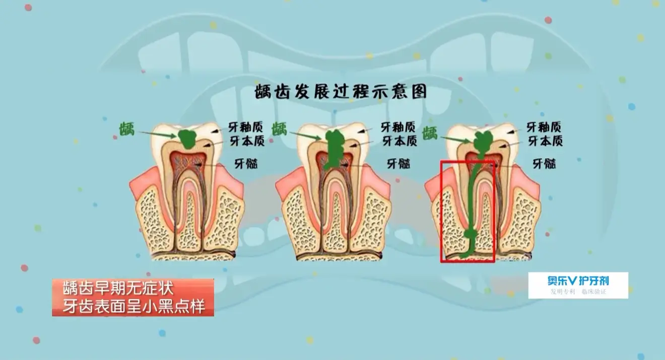 儿童专业牙膏护牙剂带你了解不同程度龋齿的表现及其对应的治疗方法