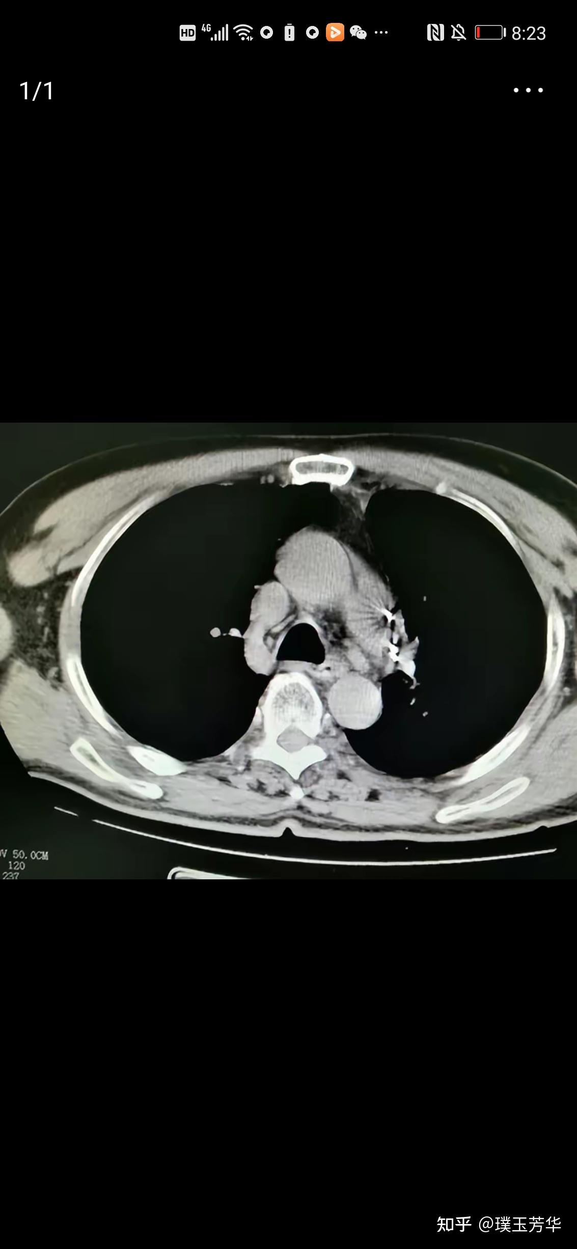 肺癌淋巴结转移怎么办?