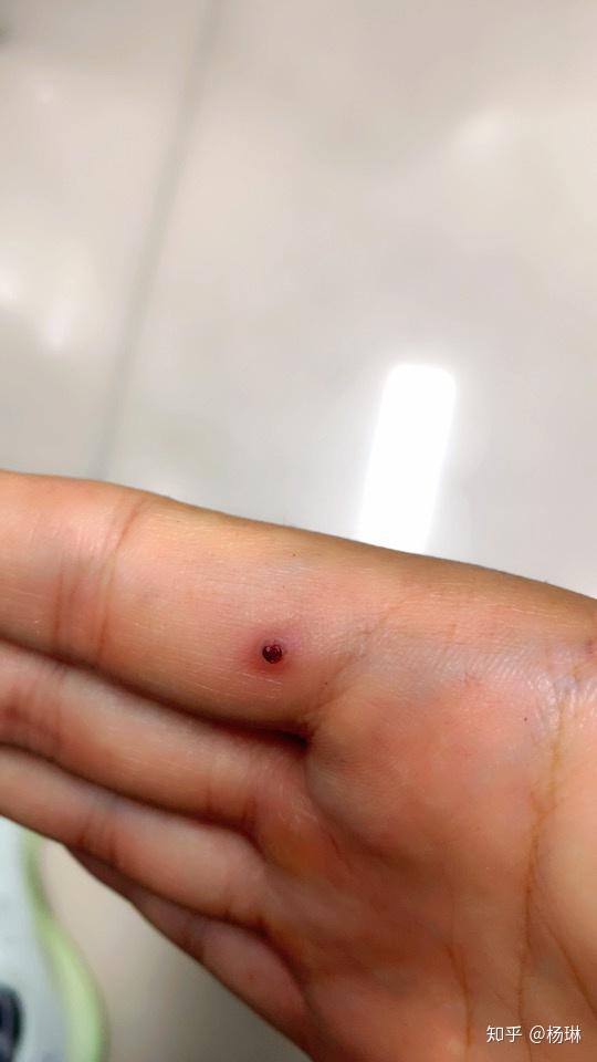 手掌长了个血泡一直不好怎么办