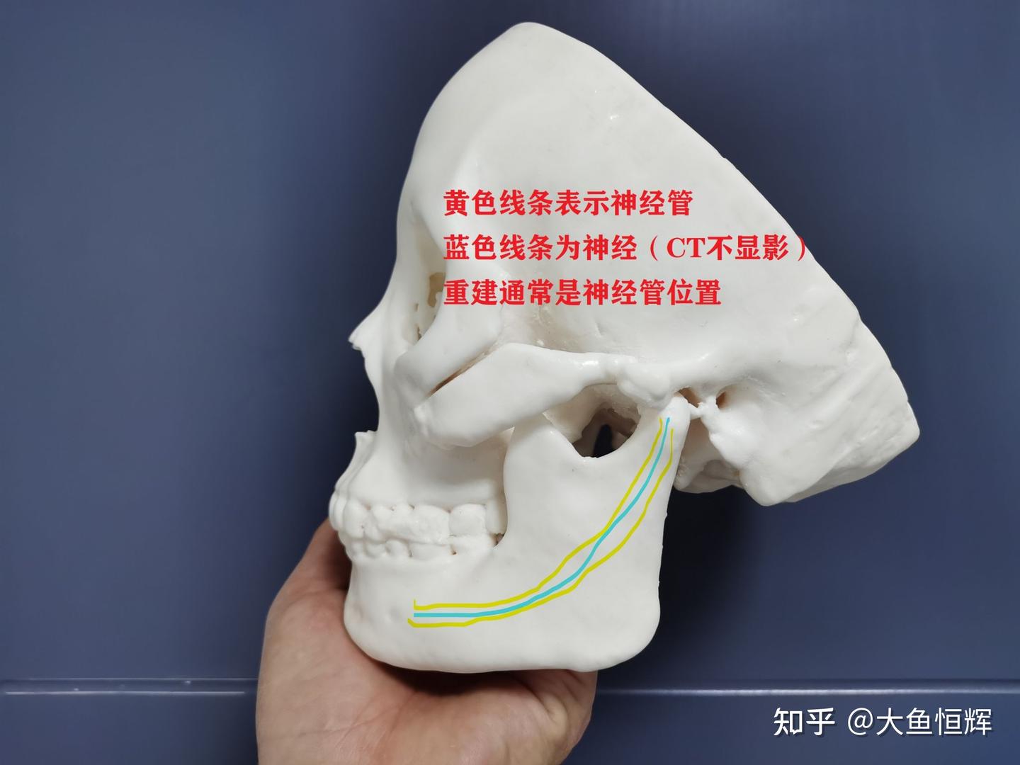 下牙槽神经重建打印模型在下颌角切除整形手术中的重要性分析 - 知乎