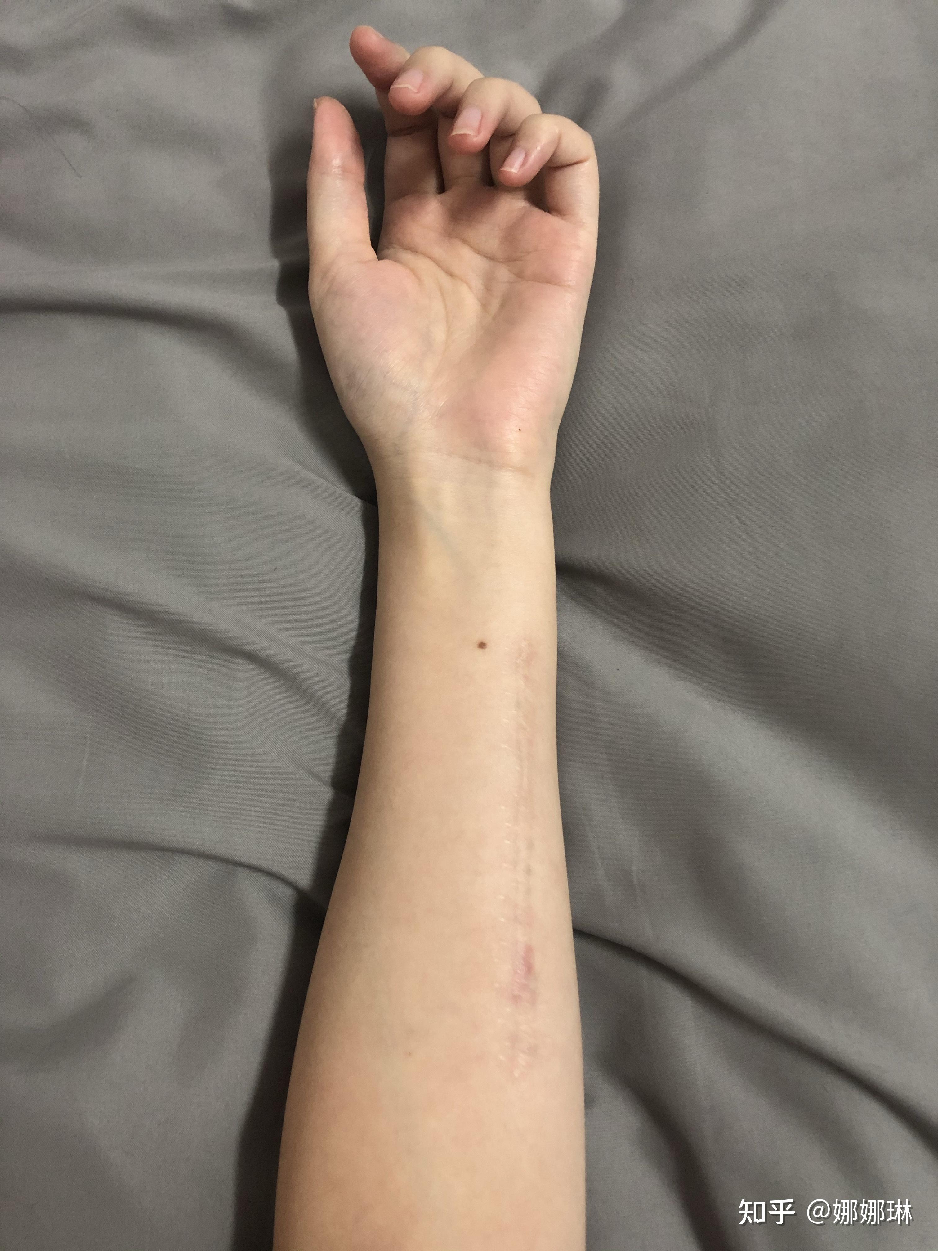 2020年纹身切除日记