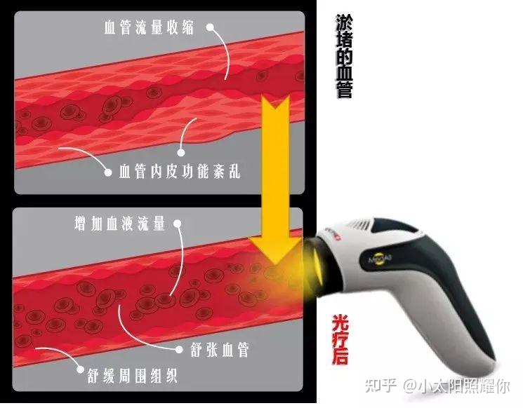 光疗知识:“推动”一氧化氮,守护血管健康! - 知乎