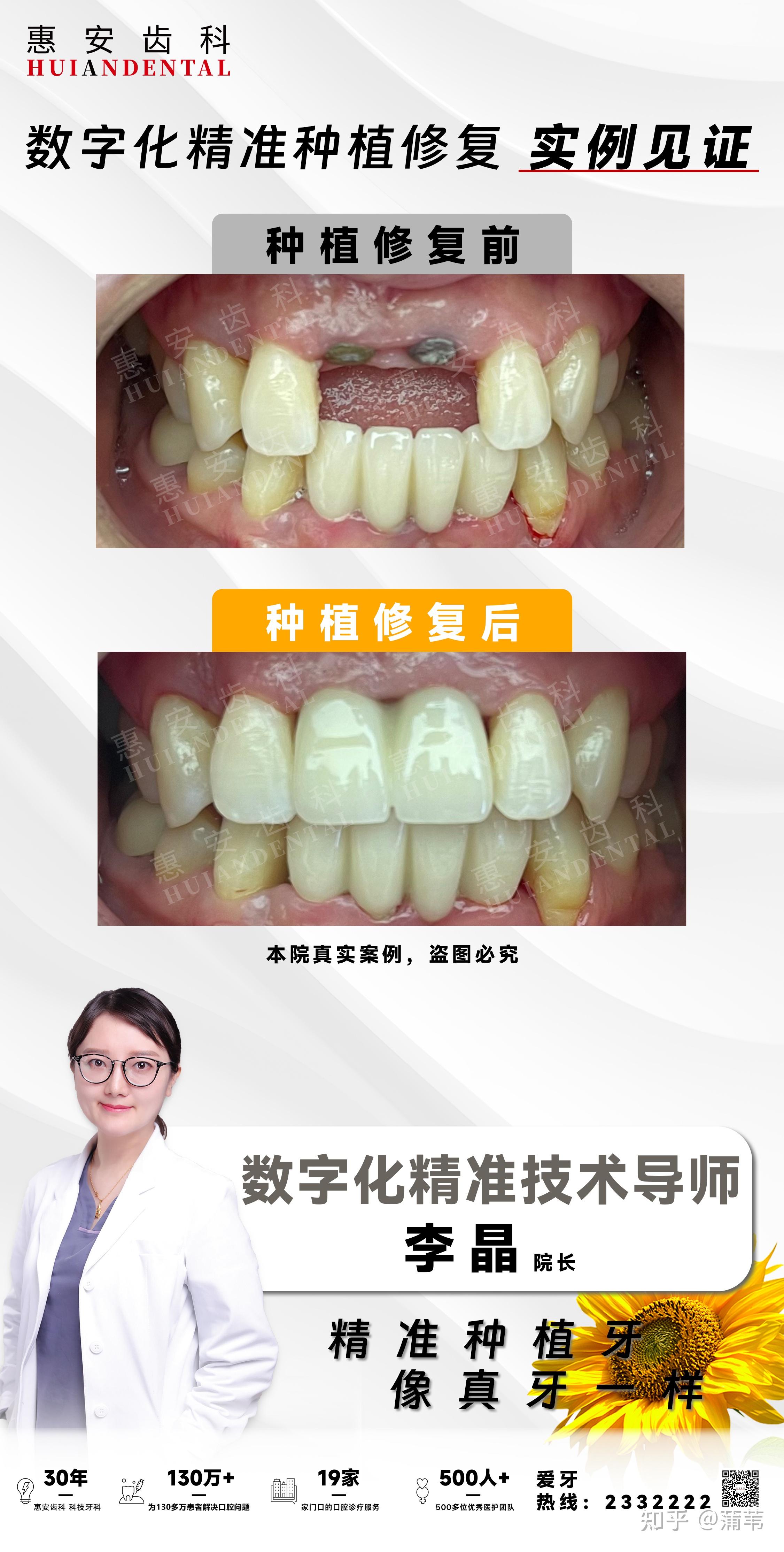 种植牙修复案例