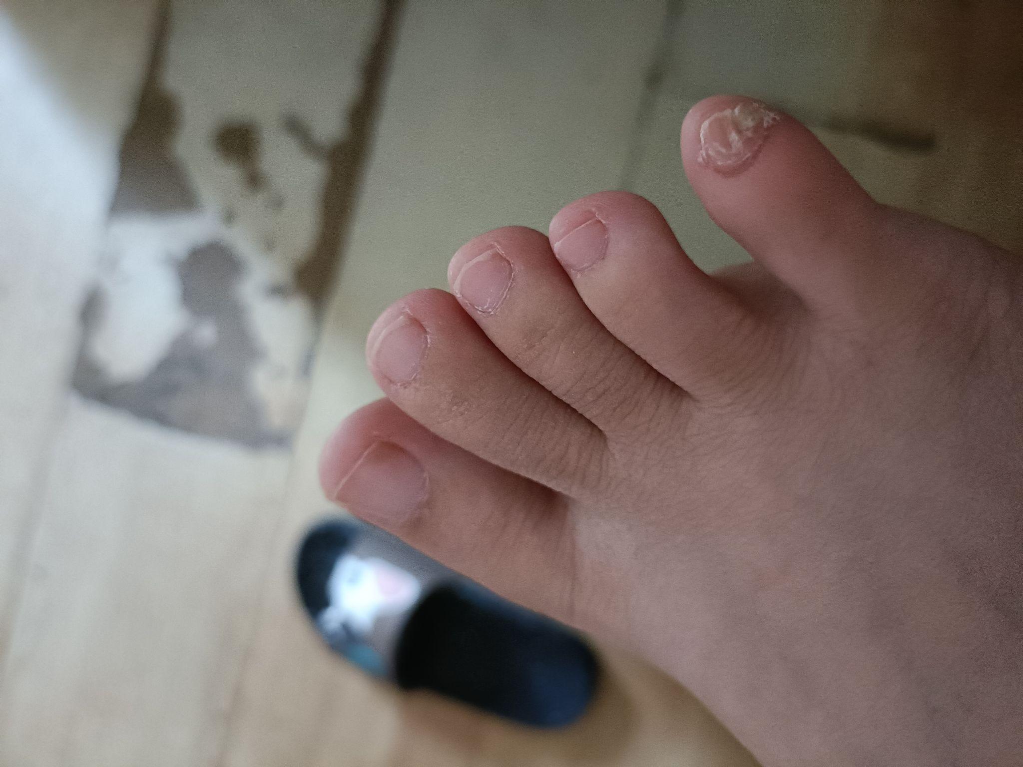 小脚趾的指甲特别难看怎么办