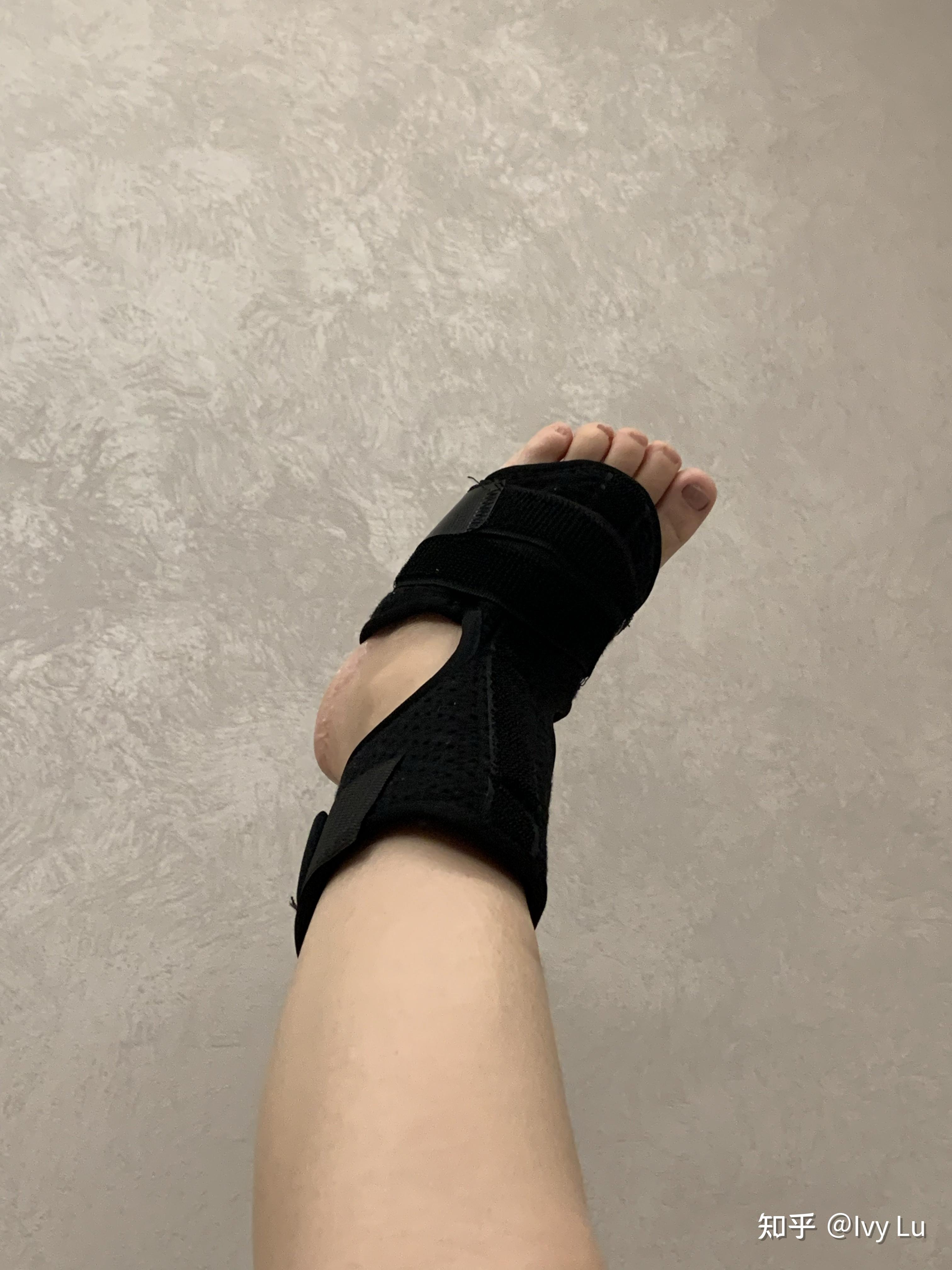 左脚第5趾骨骨折 之 治疗 生活日常记录(202111