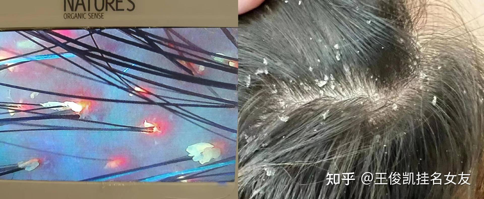 我激动的睡不着了!本医学生大把掉发、长头皮屑、头痘、头痒,就这么被洗好了?! - 知乎