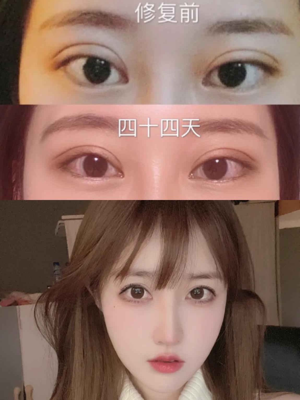 双眼皮修复成功率高吗?国内热门医生案例 价格测评