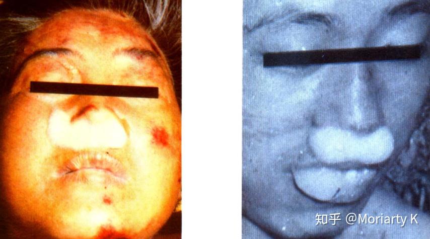 法医学讲堂第拾玖期深度解析蕈样泡沫的形成机制