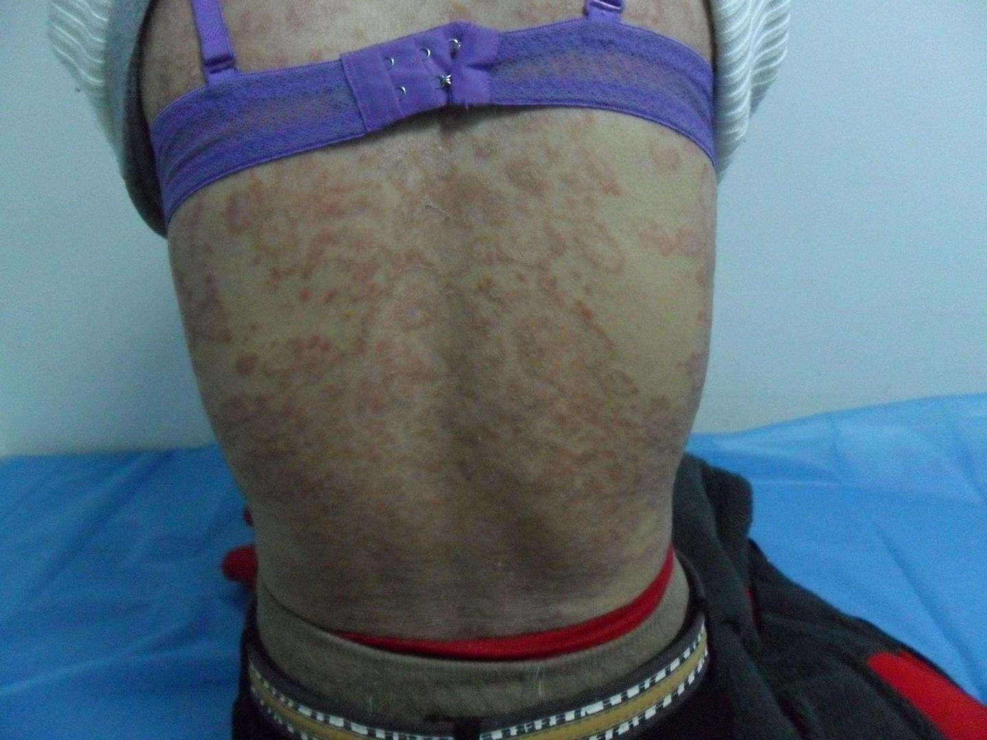 顽固性皮炎牛皮癣的前世与今生