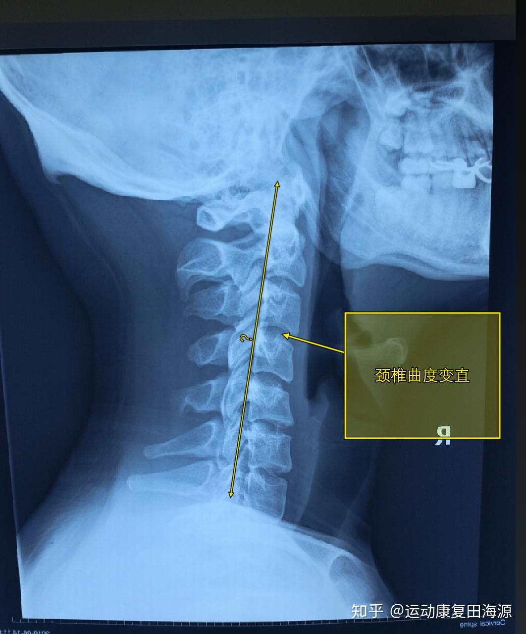 儿童寰枢椎半脱位表现图片
