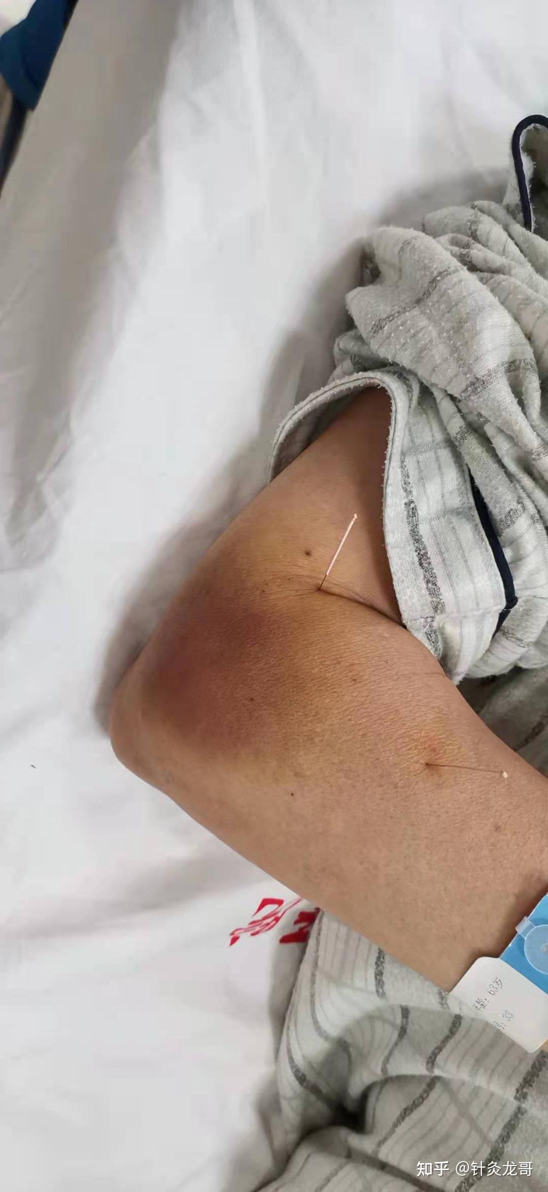 穴位下面的组织有血管,有神经,肌肉等等,针刺时看不见皮下的血管,当刺