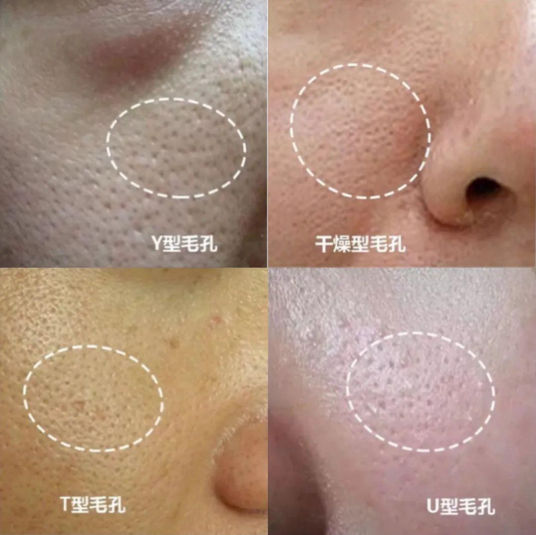 太夸张了,看完这篇才知道自己的毛孔已经不可逆了~ - 知乎
