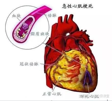 深度剖析隐身的杀手急性心肌梗死