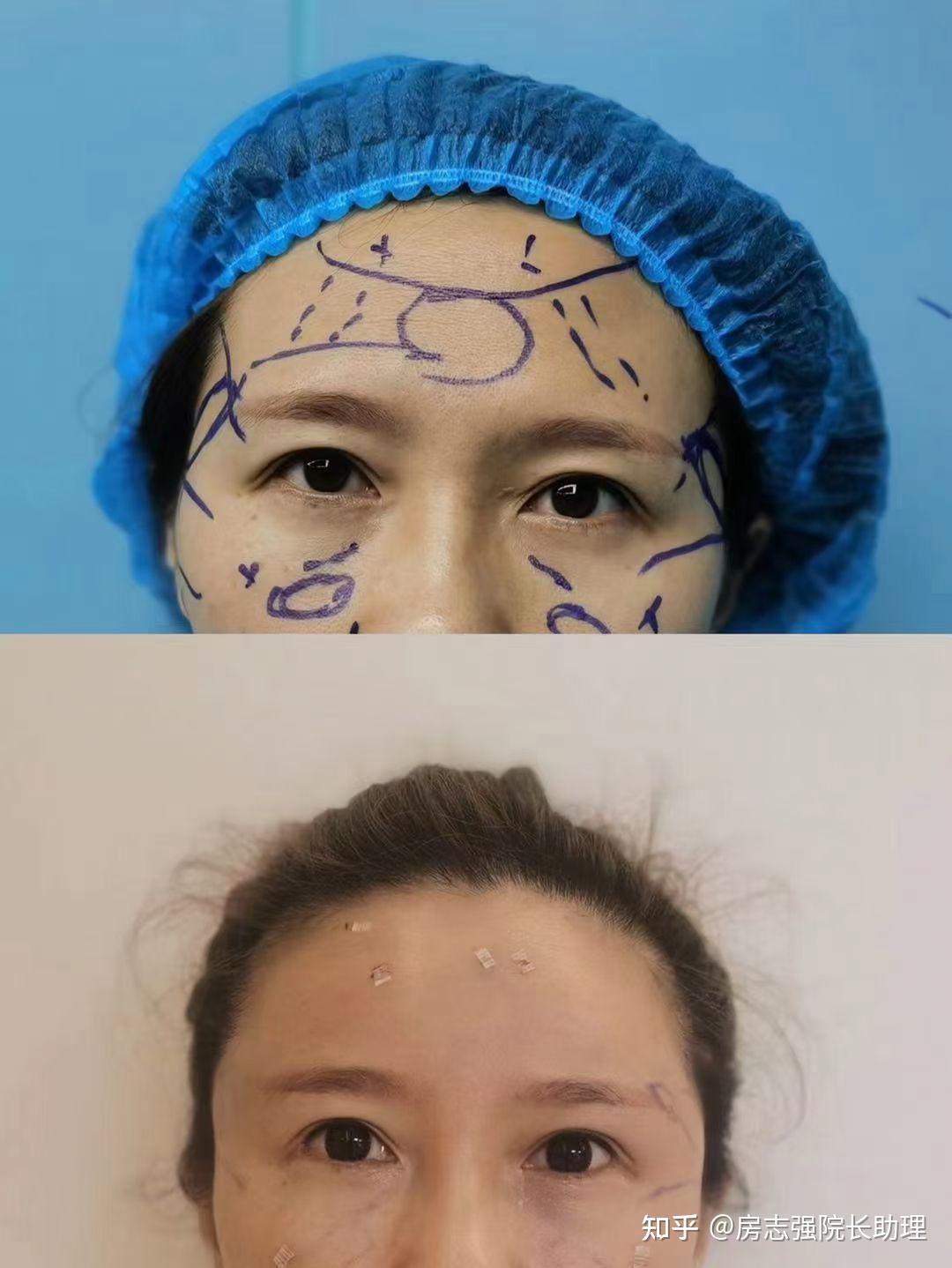 在韩国做面部吸脂+全脸脂肪填充花了4.5万元，三天回国后恢复的越来越自然 - 美佳网