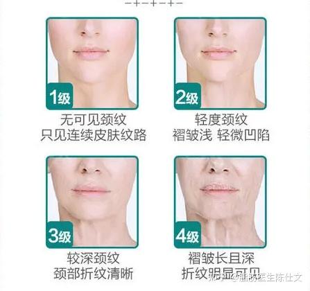 二,颈纹的分级5,日常疏于护理颈部,或护理不当,也是颈部薄弱肌肤易生