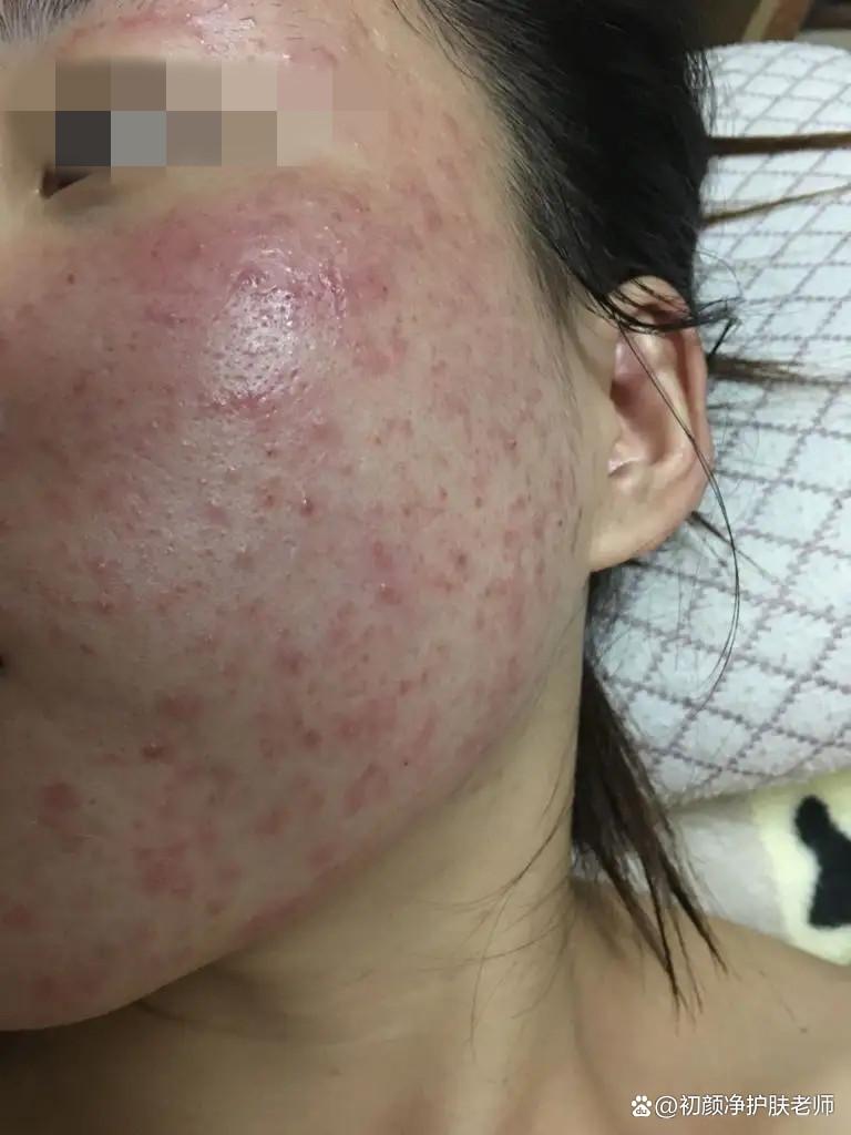 激素脸修复需要多长时间?我用亲身经历来教你 - 知乎