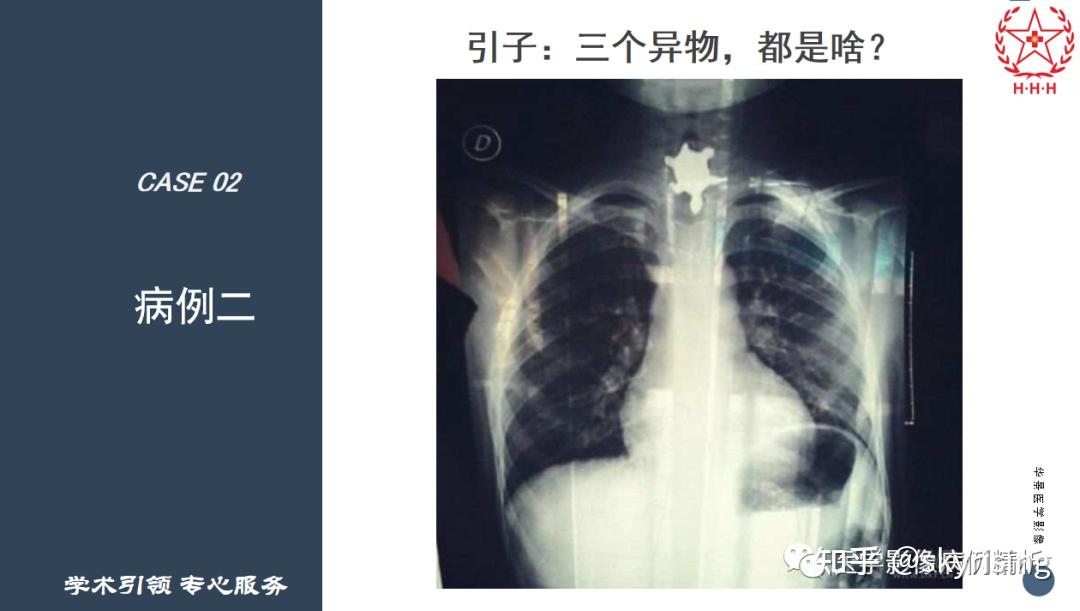 【继教专题】影像科急诊那些事儿之异物篇 - 知乎