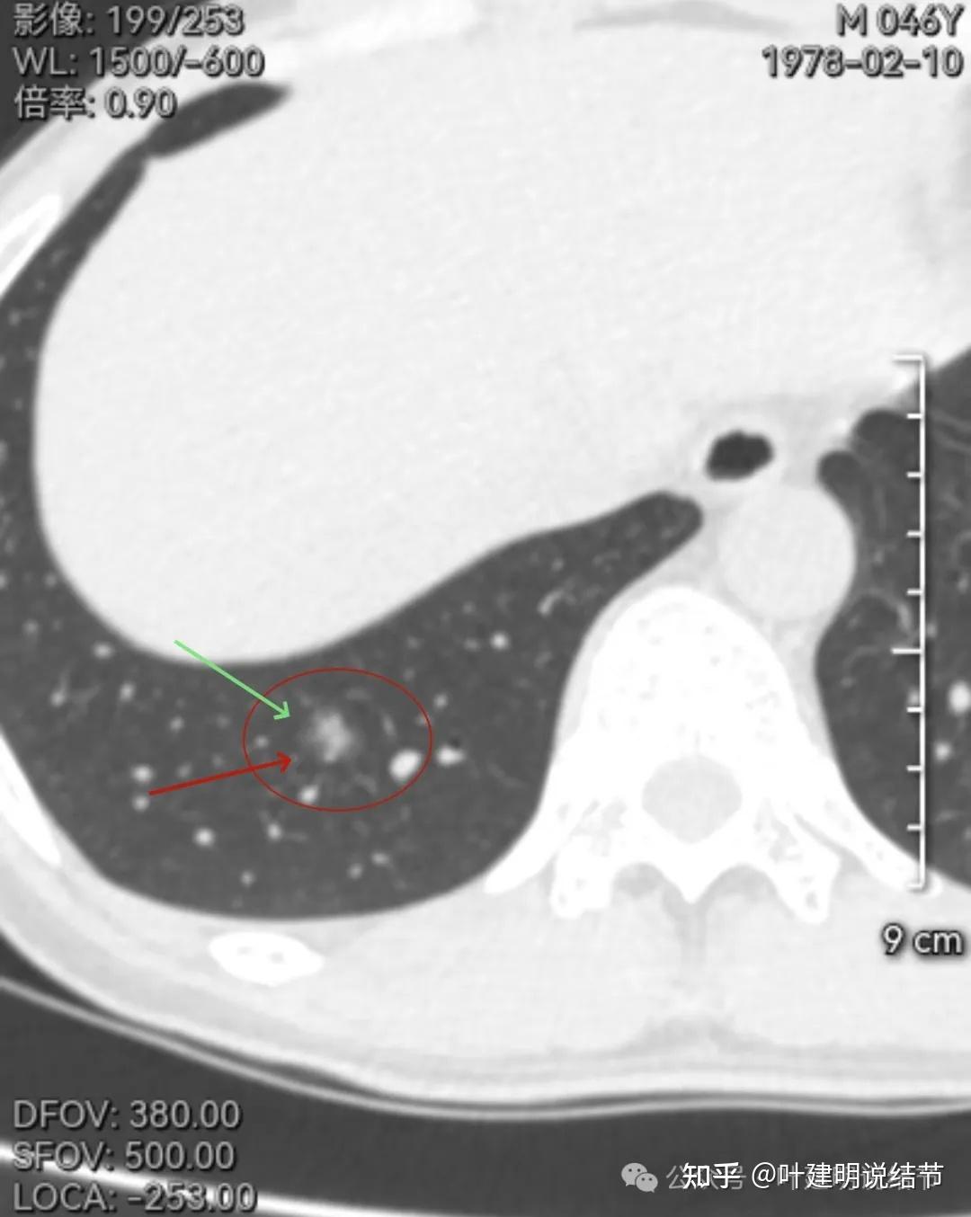 7.24):3年没复查的混合磨玻璃结节进展了!我给他切了,却不是癌!